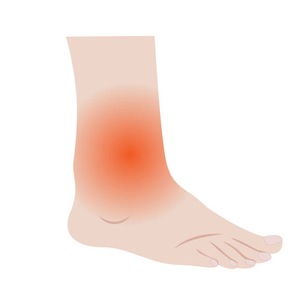 Swelling of the feet and ankles from infected or injury Swelling of the feet and ankles from infected or injury vector illustration on a white background isolated big feet cartoon stock illustrations
