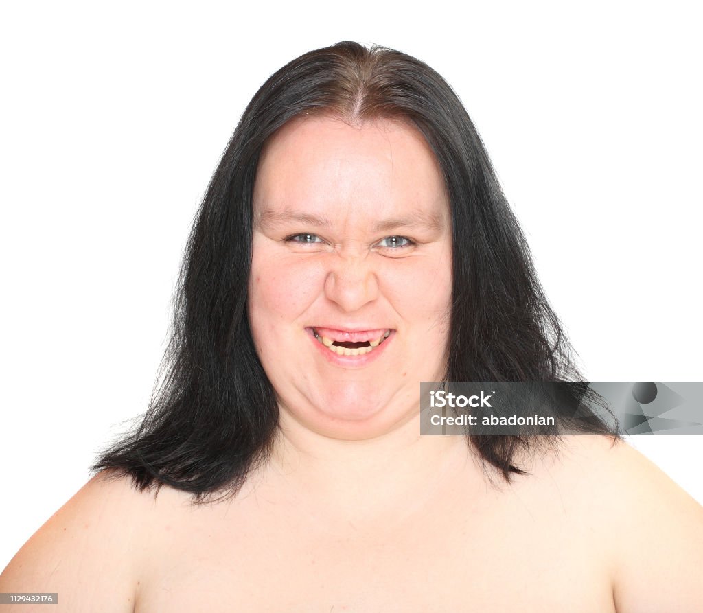 Very ugly woman with missing teeth. Unhealhty eating person. Hygiene and dental health theme. Symptoms and medical condition. Ugliness Stock Photo