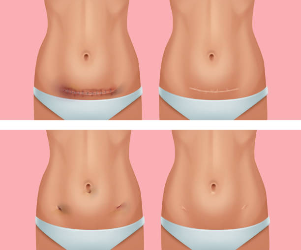 Vector set of fresh and healed scars on body after abdomen, wound from appendicitis removal surgery on background Vector set of fresh and healed scars on body after abdomen, wound from appendicitis removal surgery on pink background scar stock illustrations
