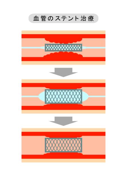 ilustrações de stock, clip art, desenhos animados e ícones de vascular stent treatment - 3144