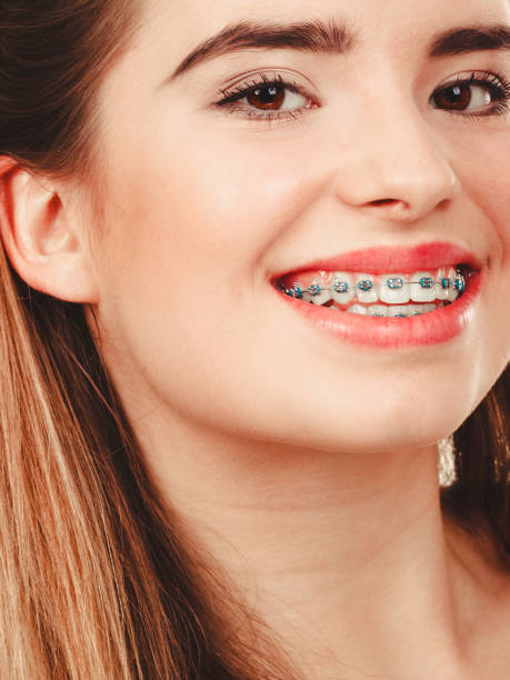 istock Woman smiling showing teeth with braces 1129900194
