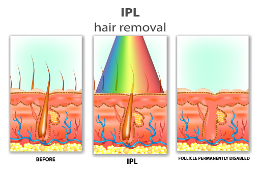 IPL (Intense Pulsed Light). How IPL Hair Removal Works