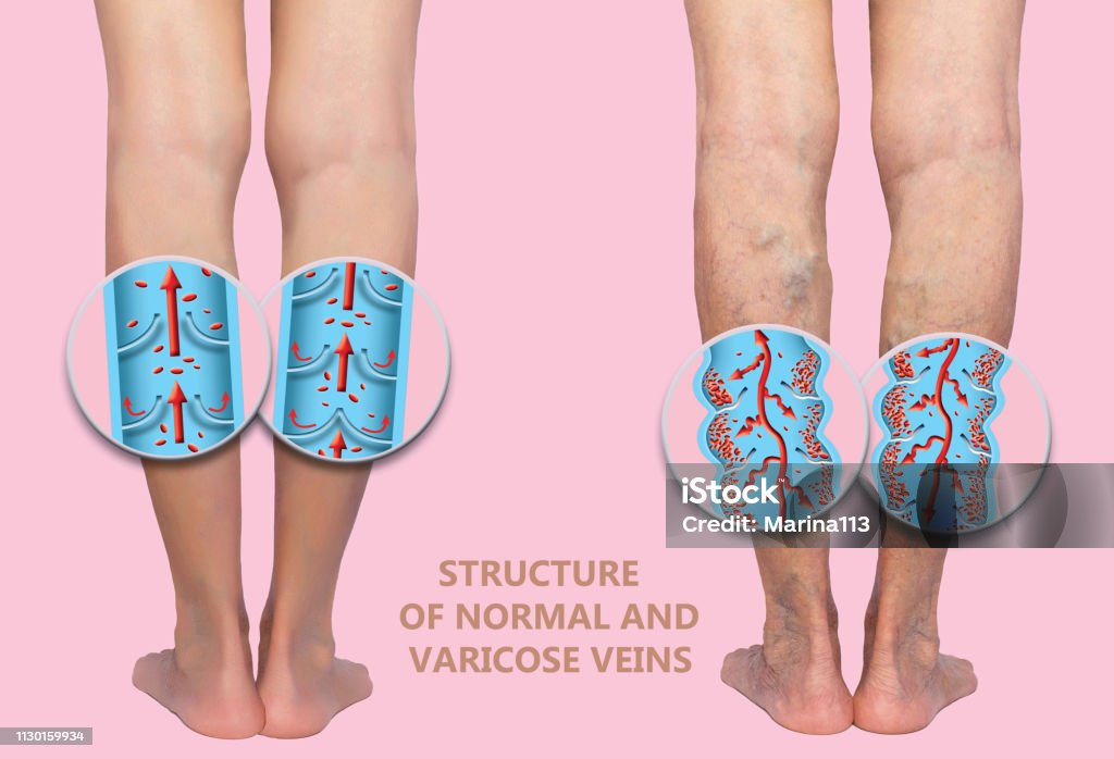 Krampfadern an eine weibliche senior Beinen. Die Struktur der normalen und varicose Adern. - Lizenzfrei Alter Erwachsener Stock-Foto