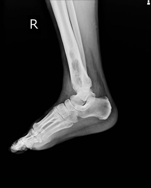 istock X-ray Rt.Ankle finding intramedullary osterolytic lesion of right distal tibia 1130194290