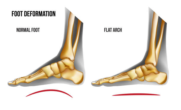 ilustrações, clipart, desenhos animados e ícones de vista medial arco de anatomia pé plano - arch top