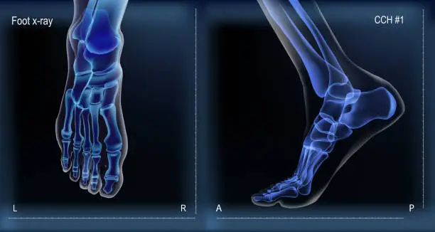 Vector illustration of Medial and top view x ray of bones the of foot.