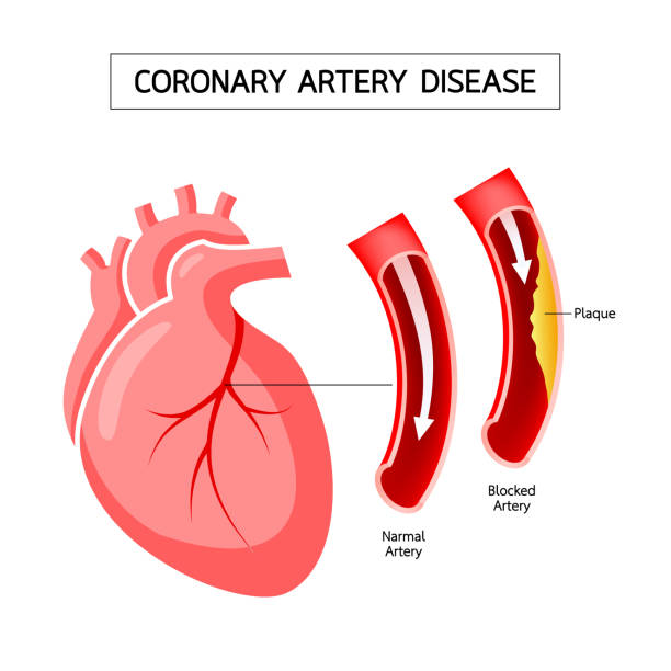 Human heart with Coronary Artery Disease info graphic. Blocked artery, heart awareness concept. Illustration isolated on white background. clogged artery stock illustrations