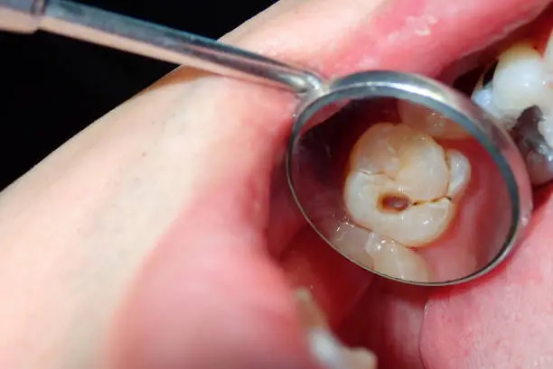 A dental tooth decay cavity found during routine dental examination check up using a dental mirror reflection