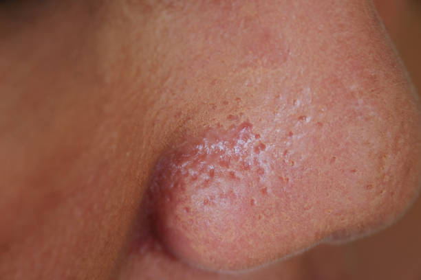istock Pores on the woman's nose 1130412744