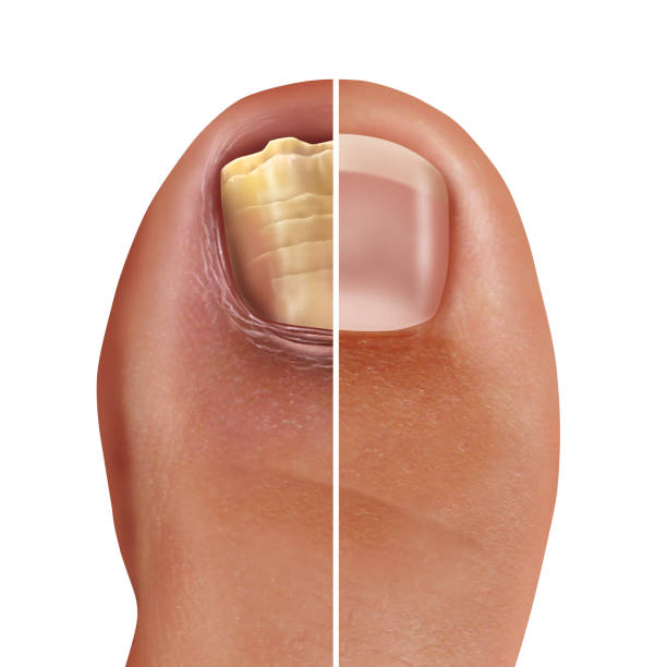 nagel pilz-infektion - fungus toenail human foot onychomycosis stock-fotos und bilder