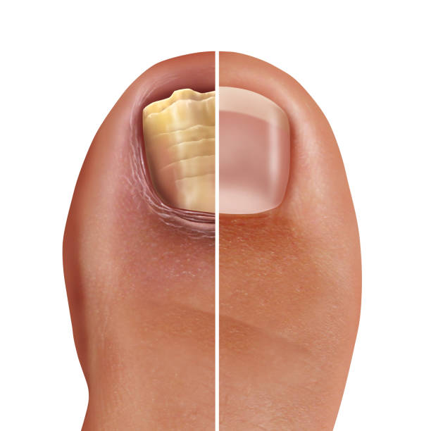 grzybicze zakażenie paznokci - fungus toenail human foot onychomycosis zdjęcia i obrazy z banku zdjęć