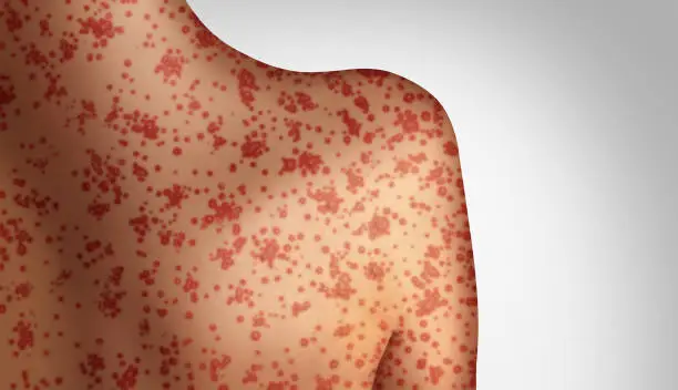 Measles concept as a deadly outbreak immunize,disease and viral illness as a contagious chickenpox or a skin rash in a 3D illustration style.