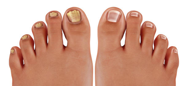 爪真菌症 - fungus toenail human foot onychomycosis ストックフォトと画像