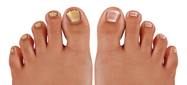 grzybica paznokci - fungus toenail human foot onychomycosis zdjęcia i obrazy z banku zdjęć