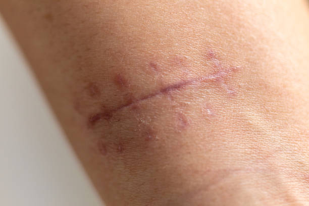 A scar is an area of fibrous tissue that replaces normal skin after an injury on skin. A scar is an area of fibrous tissue that replaces normal skin after an injury on skin. atrophy photos stock pictures, royalty-free photos & images