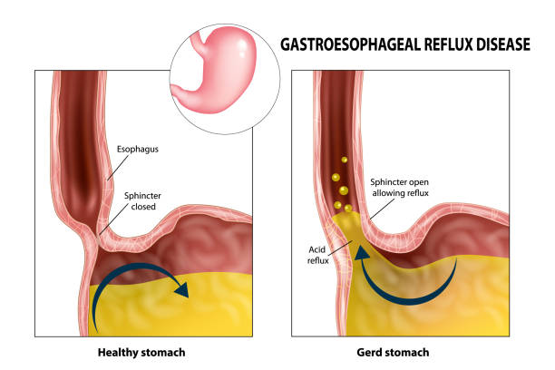 Gastroesophageal reflux disease Gastroesophageal reflux disease (Gerd or Heartburn).  Acid reflux sphincter stock illustrations