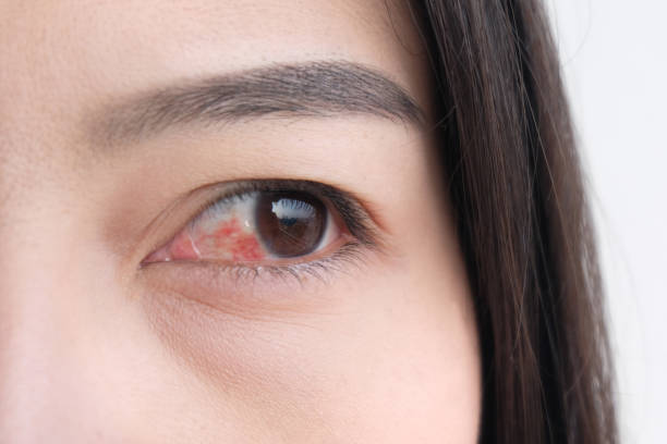 istock red eye. conjunctivitis or irritation of sensitive eyes. 1130625414