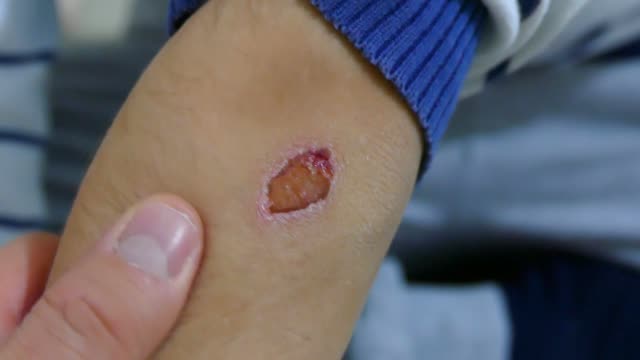 arm injured child, bicycle accidents and arm injured child, close-up crustacean wound HD video,
