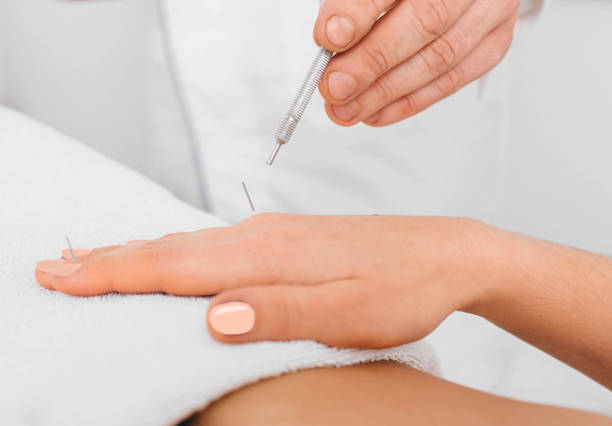 istock Client having acupuncture treatment on special points on the body 1130730063