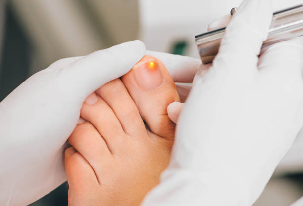 laser treatment on toenail, fungal infection on the toenails Patient receiving laser treatment on toenail, close-up. Fungal infection on the toenails. Onychomycosis treatment at clinic with medical laser toenail stock pictures, royalty-free photos & images