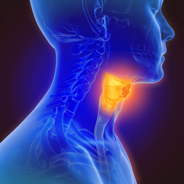 3d illustration of throat cancer - cancer imagens e fotografias de stock