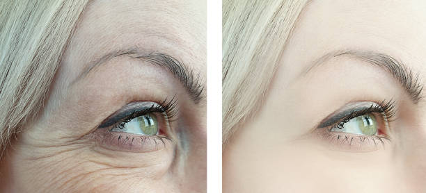 istock female eye wrinkles before and after retouching procedures 1130890922