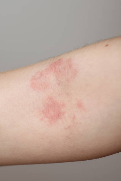 istock Diathesis on the baby's hand close-up. Problem skin on the arm. 1130906084