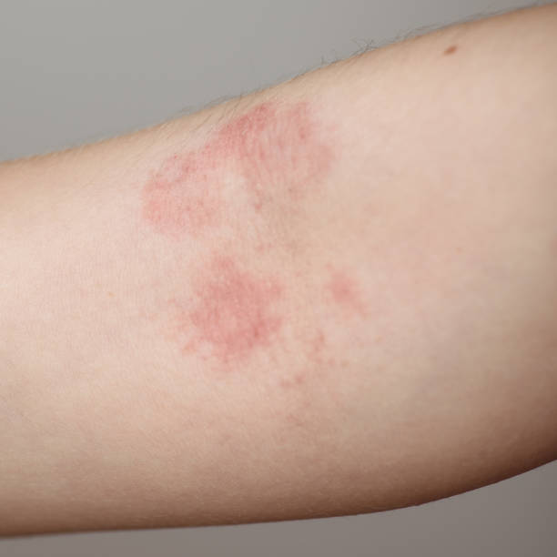 istock Allergy on the baby's hand close-up. Problem skin on the arm. 1130906106