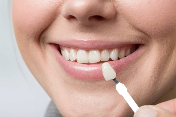 istock Using shade guide at woman's mouth to check veneer of tooth crown 1130911988