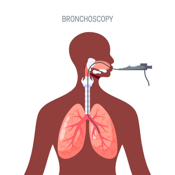 フラットスタイルの肺診断ベクターデザイン - human lung tuberculosis bacterium emphysema human trachea点のイラスト素材／クリップアート素材／マンガ素材／アイコン素材