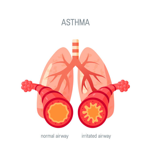 Asthma disease vector icon in flat style Asthma disease concept. Vector illustration in flat style for medical atlases, articles, infographics etc. asma stock illustrations