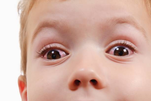 Eye child allergy and conjunctivitis red allergic,  pinkeye. stock photo