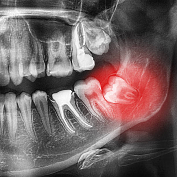 radiographs of the teeth, orthopantomogram of the dentition, the lower wisdom teeth are the eighth teeth are tilted, dystopia, polurethane, retention, x-ray, pathology, complex wisdom teeth stock photo