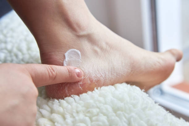 ragazza spalma piedi secchi crema coperti di crepe - pedicure human foot podiatrist moisturizer foto e immagini stock