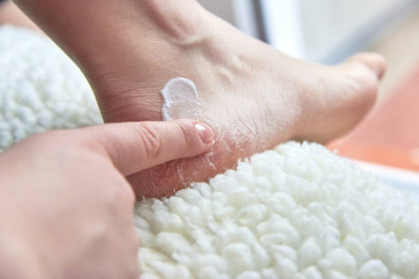 девушка мазки крем сухие ноги покрыты трещинами - pedicure podiatrist human foot moisturizer стоковые фото и изображения