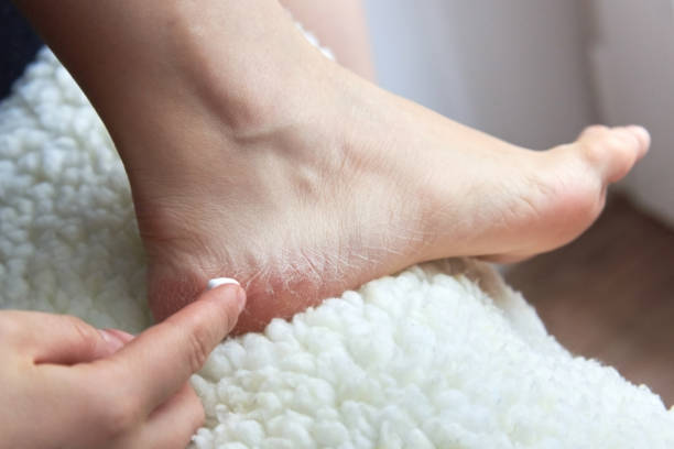 ragazza spalma piedi secchi crema coperti di crepe - pedicure podiatrist human foot moisturizer foto e immagini stock