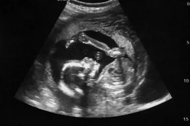 Photo of Ultrasound with pregnancy Obstetric of fetus Medical images. pregnant mother.