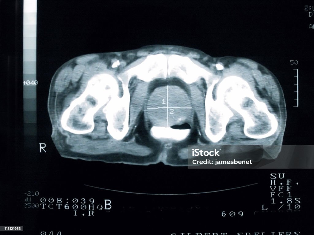 Prostatakrebs Cross Section - Lizenzfrei Prostatakrebs Stock-Foto