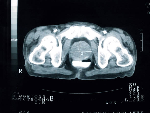 Prostatakrebs Cross Section – Foto