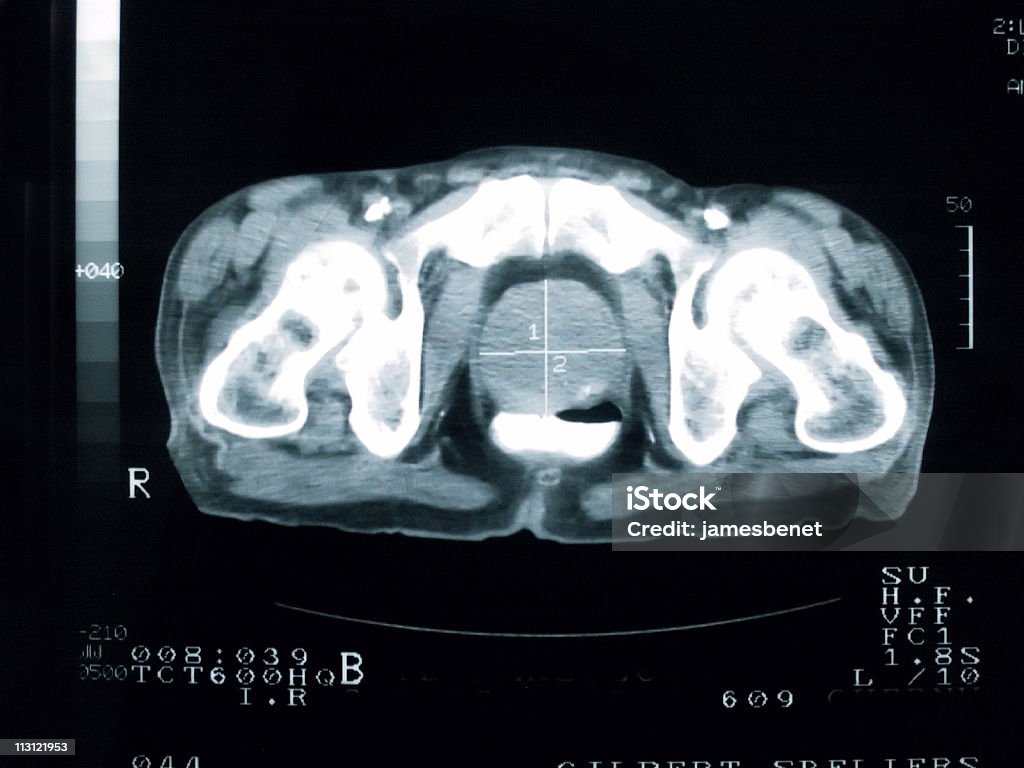 Câncer de próstata seção transversal - Foto de stock de Câncer de próstata royalty-free