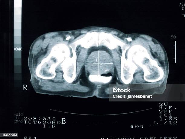 Foto de Câncer De Próstata Seção Transversal e mais fotos de stock de Câncer de próstata - Câncer de próstata, Ultrasonografia Médica - Instrumento para Diagnóstico, Exame de ressonância magnética