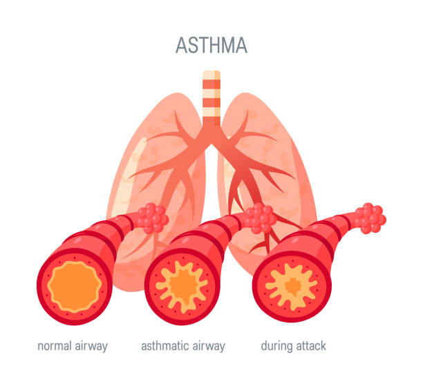 asthma-krankheit vektorsymbol im flachen stil - asthmatisch stock-grafiken, -clipart, -cartoons und -symbole