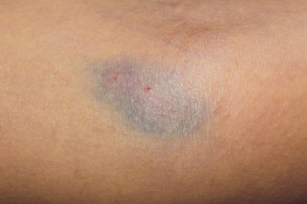 blutergüsse aus der blutentnahme isoliert. purple blutergüsse auf dem arm. - iv bruise stock-fotos und bilder