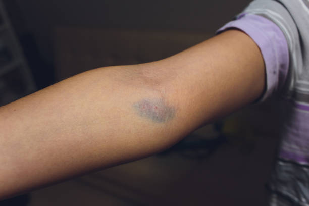 blutergüsse aus der blutentnahme isoliert. purple blutergüsse auf dem arm. - iv bruise stock-fotos und bilder