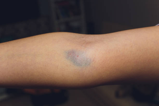 blutergüsse aus der blutentnahme isoliert. purple blutergüsse auf dem arm. - iv bruise stock-fotos und bilder