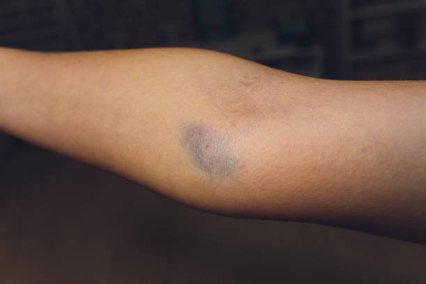 blutergüsse aus der blutentnahme isoliert. purple blutergüsse auf dem arm. - iv bruise stock-fotos und bilder