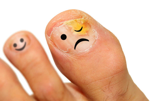 onychomycosis fungal infection of the nail.  it is the most common disease of the nails. it is an actual skin infection with the trichophyton rubrum is the most common dermatophyte. - fungus toenail human foot onychomycosis imagens e fotografias de stock