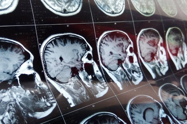 risonanza magnetica del cervello con cranio. scansione della testa della risonanza magnetica su sfondo scuro di colore blu - testa foto e immagini stock