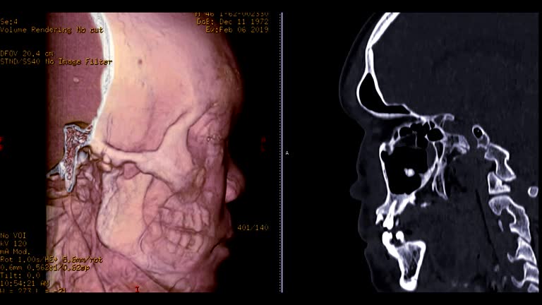 Cap Dissection Ct Face Bone Anatomy Ct