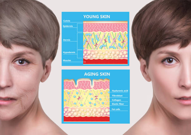 younger skin and aging skin. elastin and collagen. The younger skin and aging skin. elastin and collagen. A diagram of young and old face showing the decrease in collagen and broken elastin. diagram of skin layers pre post aging stock pictures, royalty-free photos & images younger skin and aging skin. elastin and collagen. The younger skin and aging skin. elastin and collagen. A diagram of young and old face showing the decrease in collagen and broken elastin. diagram of skin layers pre post aging stock pictures, royalty-free photos & images